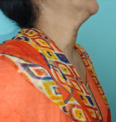Thyroid cancer