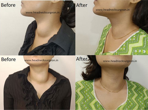 Radiofrequency Ablation