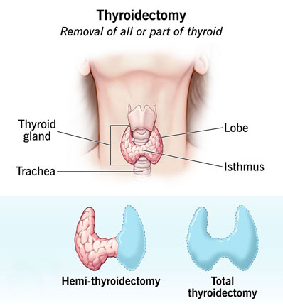 Hemi-thyroidectomy