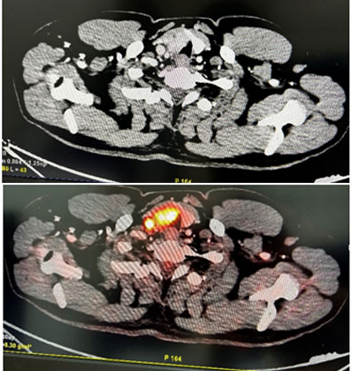 Tracheal Resection